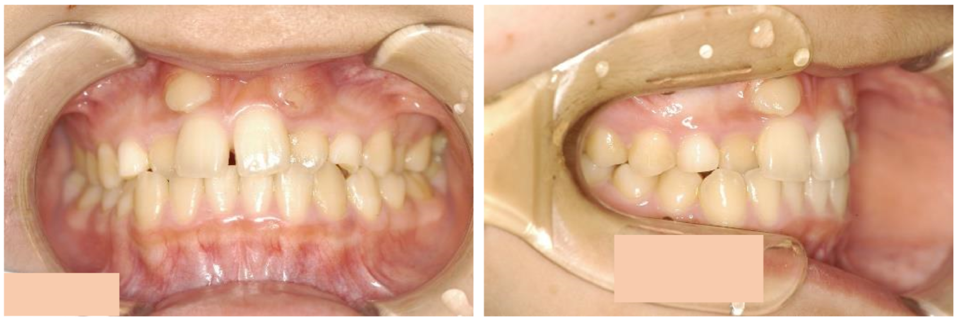 歯の位置の異常 移転歯 村田矯正歯科 豊橋市